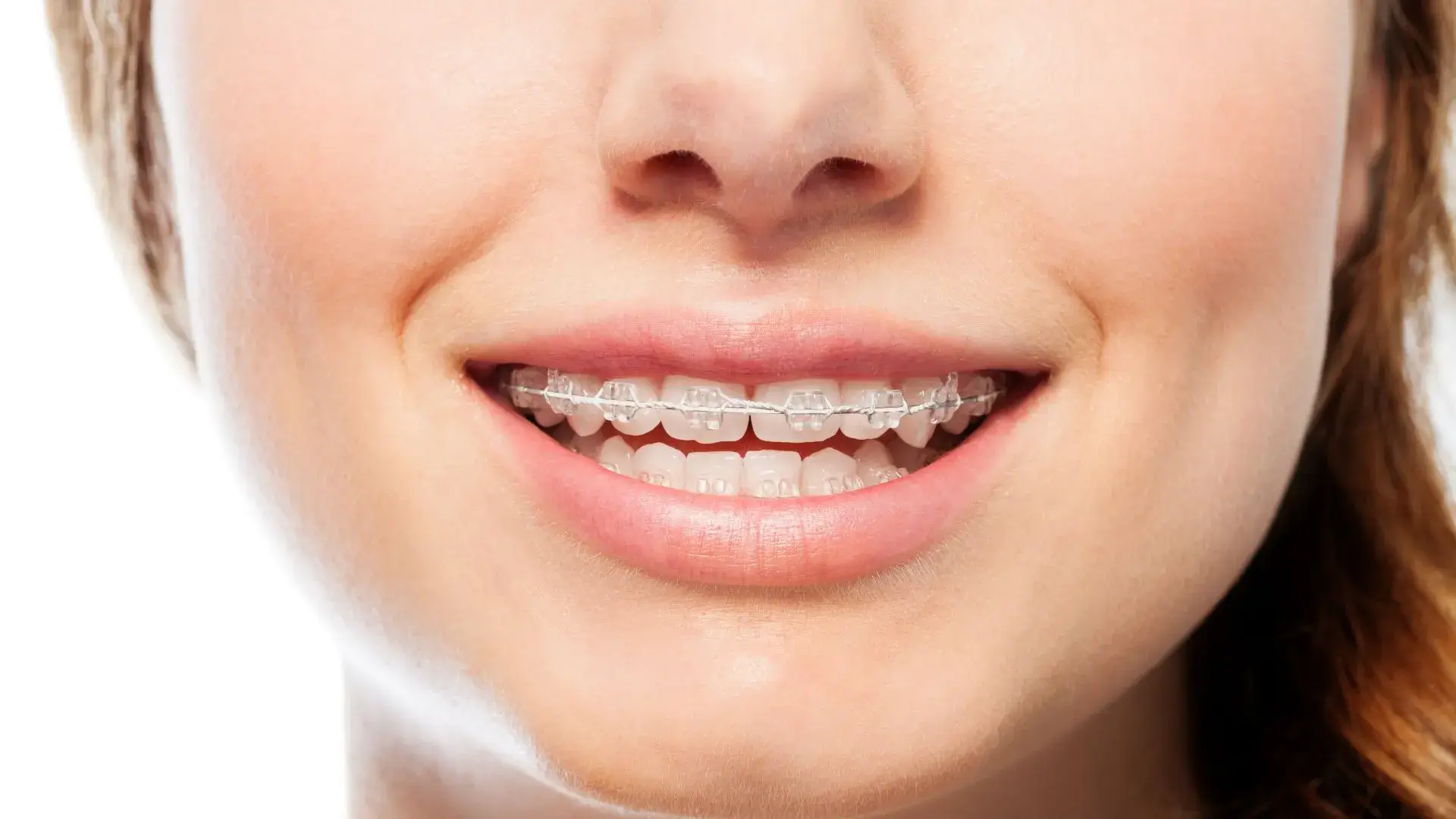 Mooresville Clear Braces