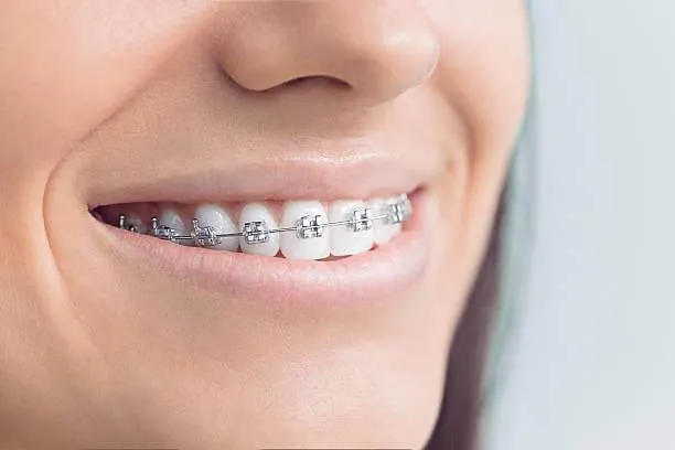 a close-up of a smiling person with braces