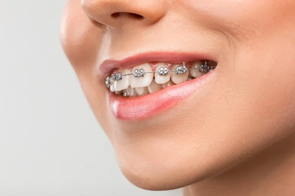 close-up shot of a person's teeth with upper braces