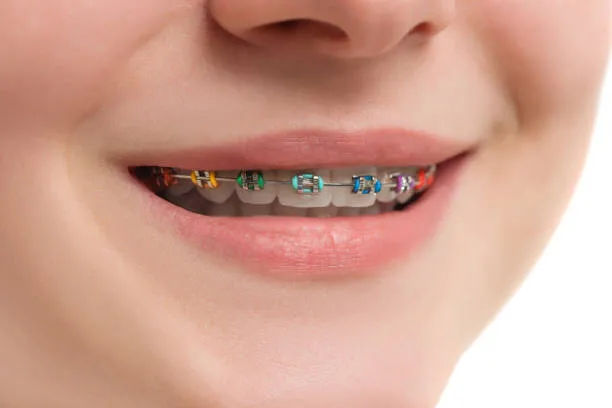 close-up shot of a person's teeth with multicolor braces
